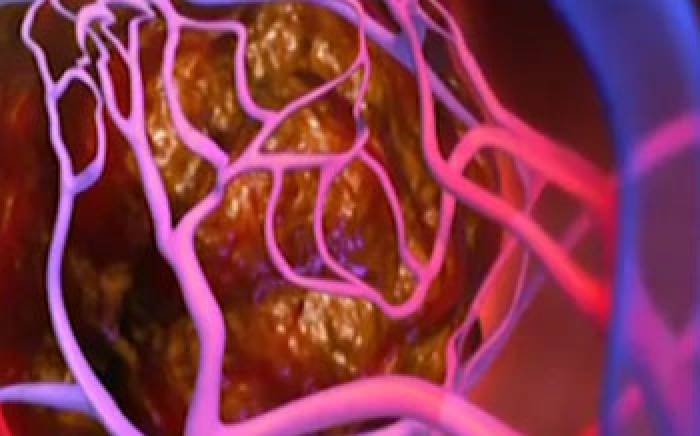 Medical Animation: Liver Cancer