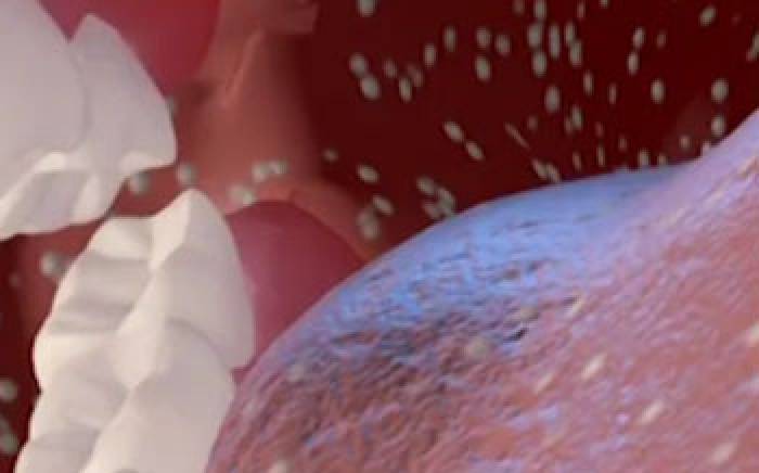 Medical Animation: Measles