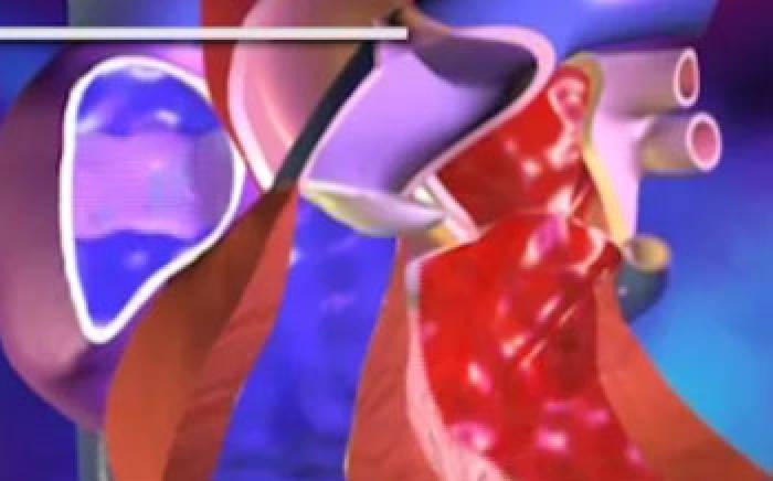 Patent Ductus Arteriosus Video