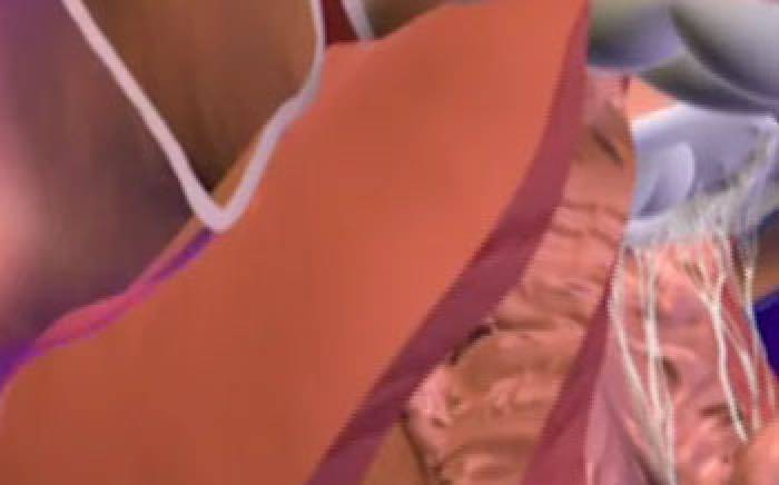 Medical Animations: Patent Foramen Ovale Closure Surgery