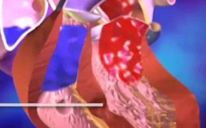 Medical Animations: Ventricular Septal Defect