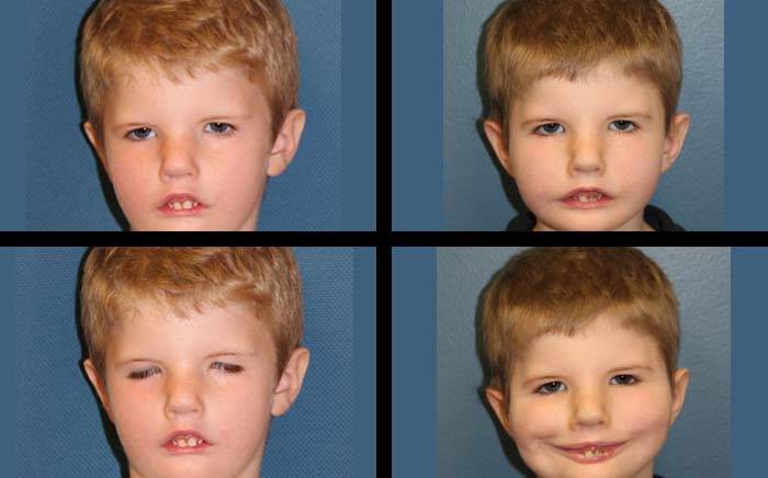 Preoperative and postoperative photos of a child with facial paralysis who was treated at St. Louis Children's Hospital.