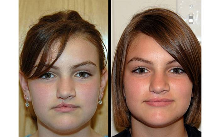 13 year old who underwent right sided cleft lip revision at St. Louis Children's Hospital in Missouri. Photo shows before and 1 year after surgery.