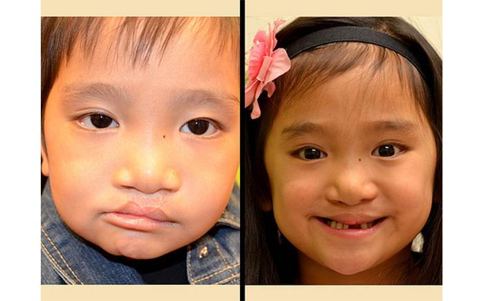 Follow-up photo 2 years after complete revision of prior bilateral cleft lip and nose repair 