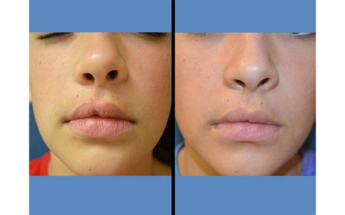 13-year-old one year after cleft lip revision.