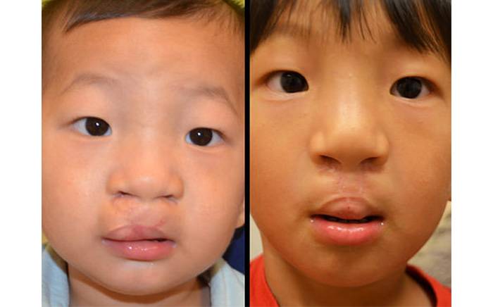 Follow-up photo is at 6 months after complete revision of his prior bilateral cleft lip and nose repair. 
