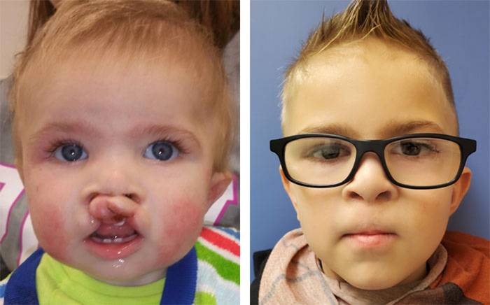 5 year-old after bilateral cleft lip and nose repair.