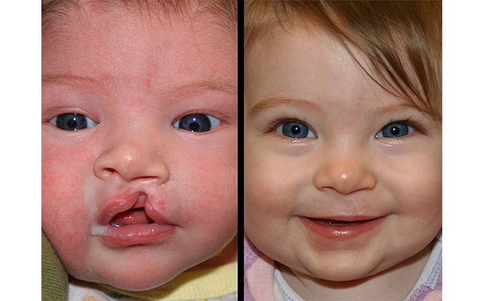 Pre op photo at age 2 months of a child with a cleft lip. The post op photo is 5 months after reconstruction.