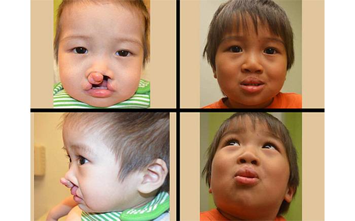Child with a bilateral complete cleft lip and palate (left). 1 year after cleft lip and nose repair (right).