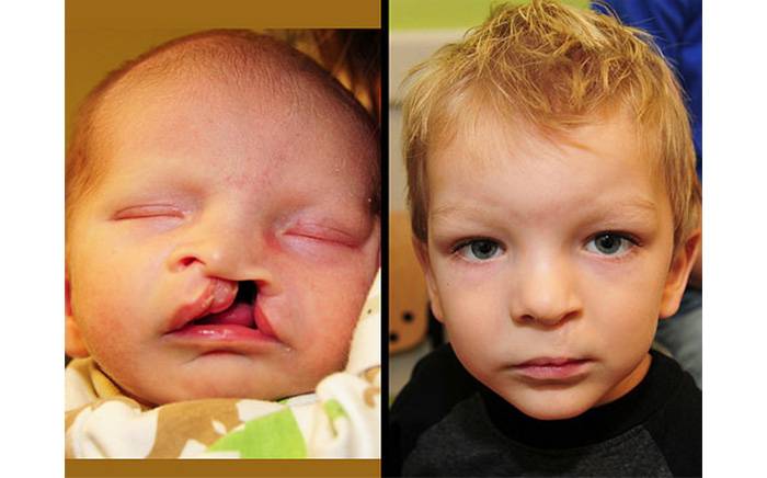 This baby boy was born with a wide left-sided cleft lip and palate. 