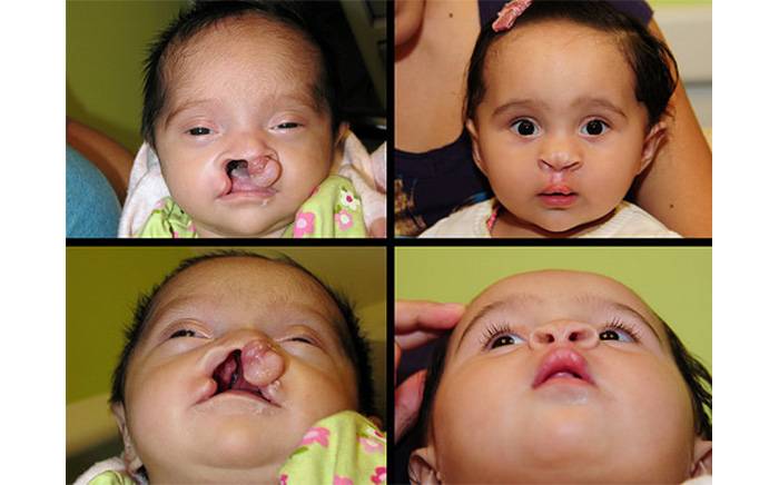 This child was born with severe, asymmetric bilateral cleft lip and palate.