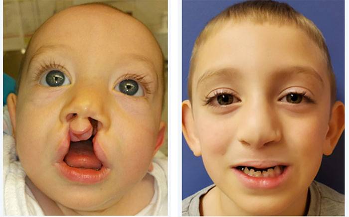 (Left) Child with a bilateral cleft lip and palate. (Right) 5-year-old after bilateral cleft lip and nose repair.