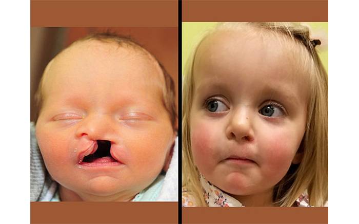 Child with a unilateral cleft lip and palate. Follow-up photo is at 2 years of age after nasoalveolar molding (NAM) and repair of lip and palate.