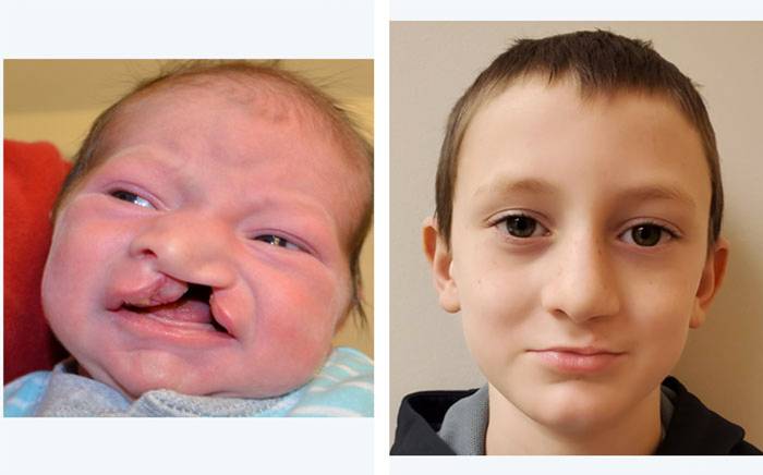 Child with a wide unilateral cleft lip and palate. Follow-up photo is after repair of his lip, nose and palate.