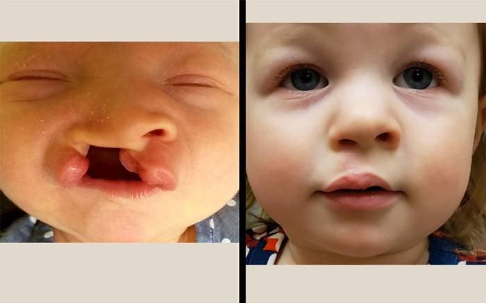 Child after unilateral cleft lip-nose repair.