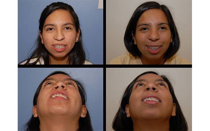 16 year old with right-sided cleft lip and palate. She underwent cleft nasal reconstruction as well as a minor revision to the cleft lip.