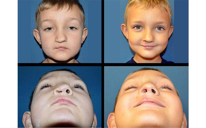 A 6-year-old boy with right unilateral cleft lip 6 weeks after revision.