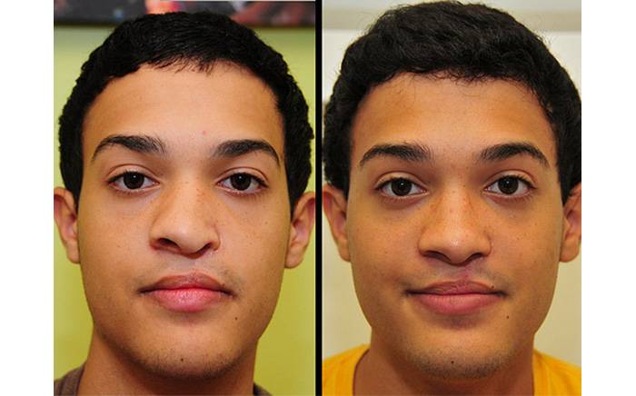 He had correction of his deviated nose and straightening of the septum to help him breathe better (septorhinoplasty).