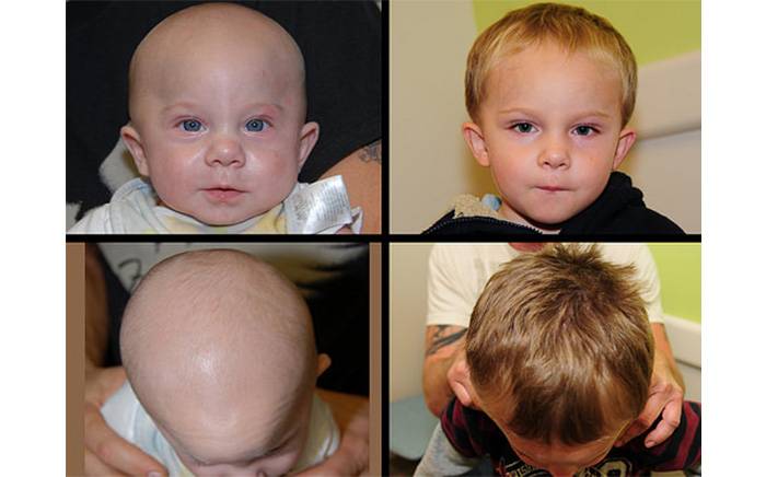 Three-year-old male who has metopic synostosis with a triangular-shaped head.
