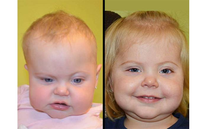 1-year post-operative after fronto-orbital advancement at St. Louis Children's Hospital for left coronal synostosis.