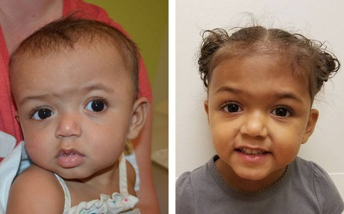 Child was born with left coronal synostosis (left). One year after open synostosis repair at St. Louis Children's Hospital (right).