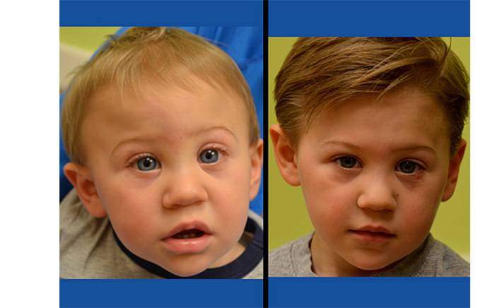 Child was born with metopic synostosis (left). (right) Two years after open synostosis repair at St. Louis Children's Hospital.