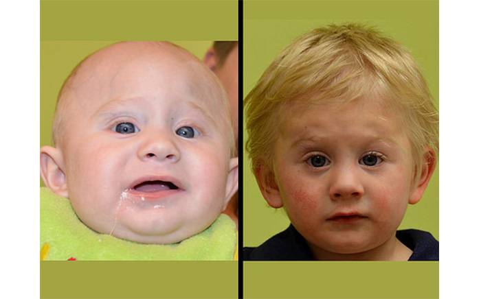 Child was born with metopic synostosis (left). (right) Two years after open craniosynostosis repair at St. Louis Children's Hospital.