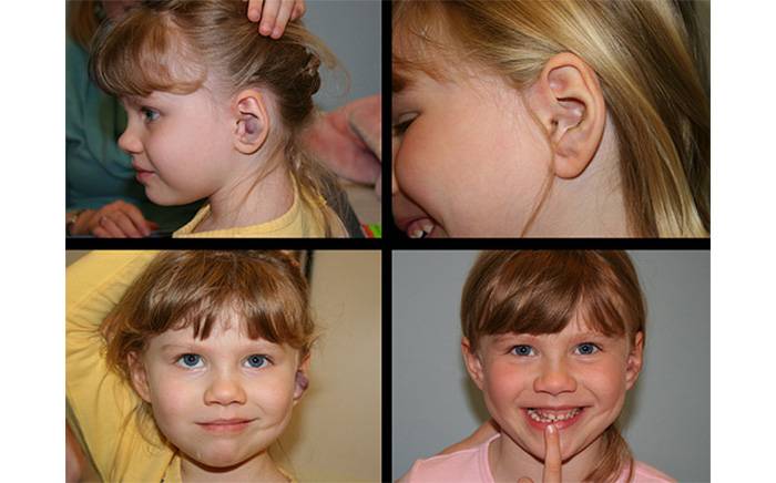 Pre op: Hemangioma of the ear. Post op: 1 month following excision of the hemangioma.
