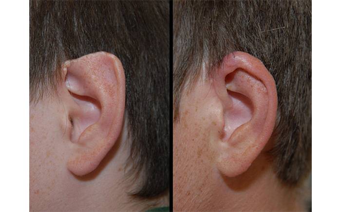 This 13 year old male had the top of his ear bitten off by a dog several years before. The following photo shows his ear 2 months after it had been reconstructed.