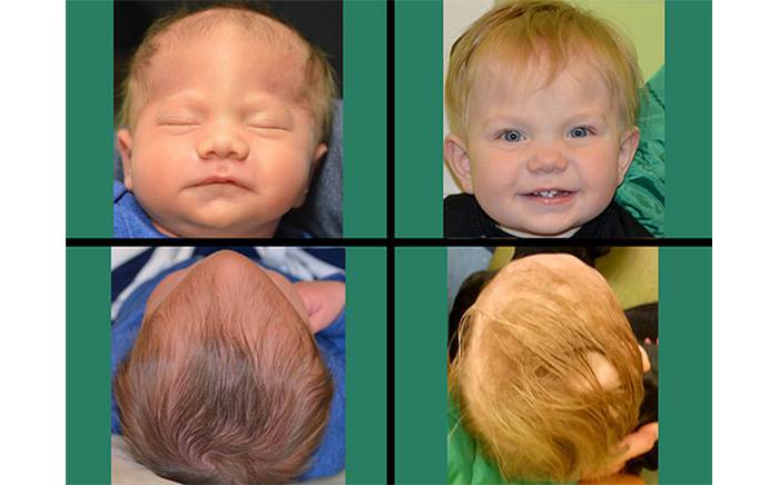 1-year-old after completion of helmet molding therapy and endoscopic-assisted treatment for metopic synostosis.