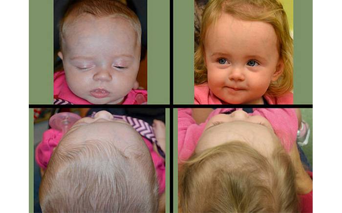 1-year-old after completion of helmet molding therapy and endoscopic-assisted treatment for left coronal synostosis.