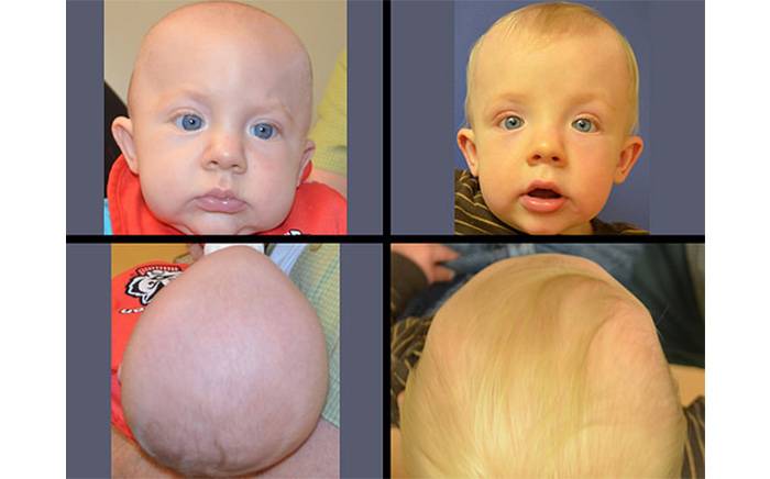 1-year-old before and after completion of helmet molding therapy and endoscopic-assisted treatment for metopic synostosis at St. Louis Children's Hospital.