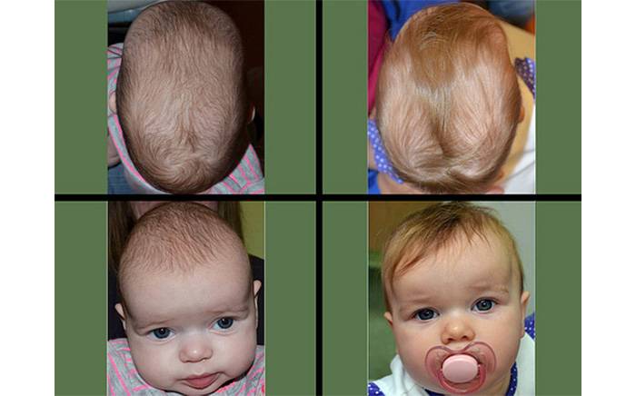 Before and after photos of a girl with Sagittal synostosis from St. Louis Children's Hospital. 
