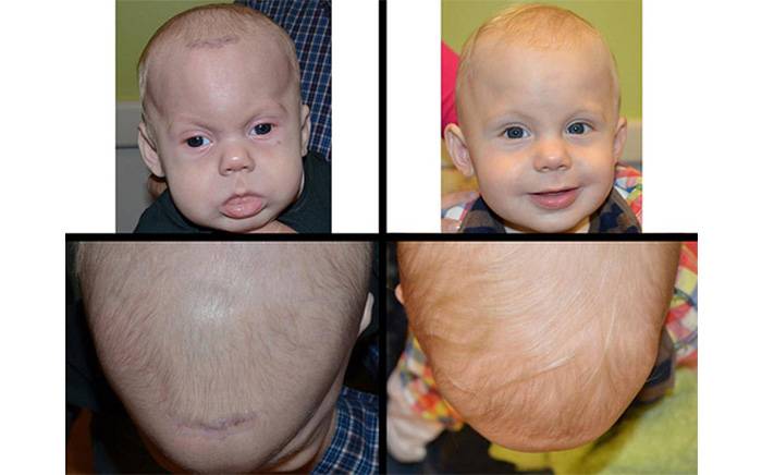 Before and after photos of a 2 month old, 3 weeks and 1 year after endoscopic treatment of metopic synostosis.