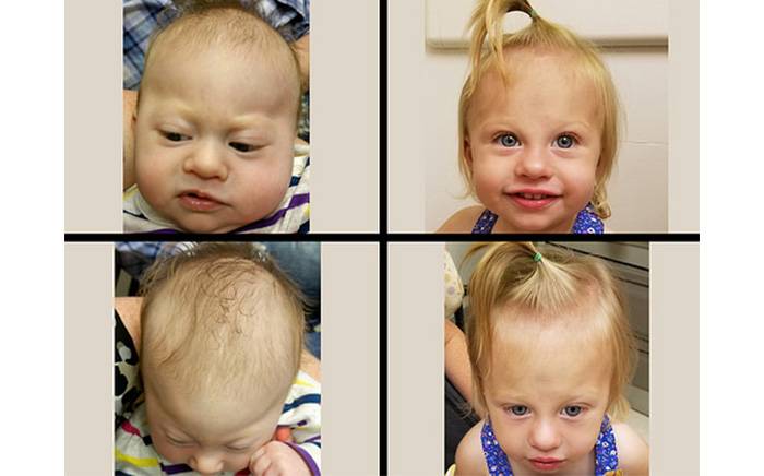 1-year-old after completion of helmet molding therapy and endoscopic-assisted treatment for metopic synostosis.