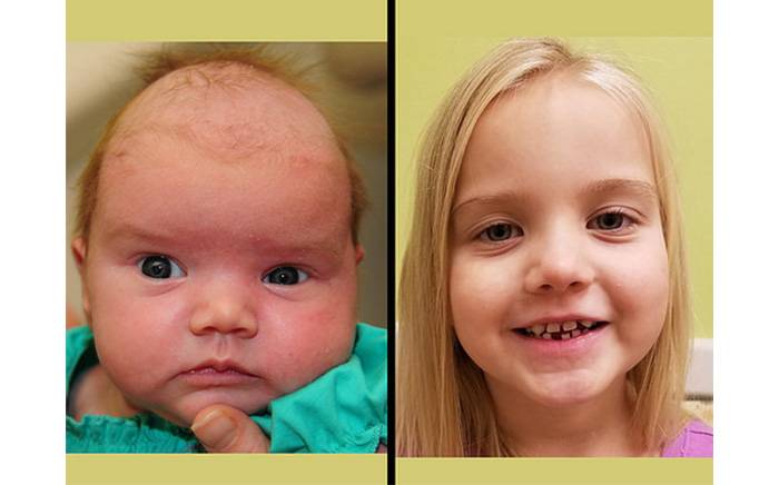 Before and after photos of a girl with Sagittal synostosis from St. Louis Children's Hospital.