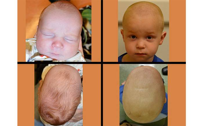 Before and after photos of a boy with Sagittal synostosis. After photo is 2 years after endoscopic repair.