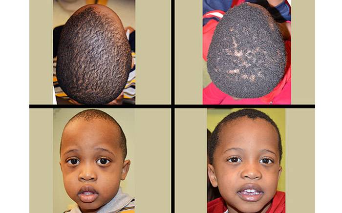 Before and after photos of three-year-old with sagittal and lambdoid synostosis 1 year after open reconstruction with a more normal head shape.