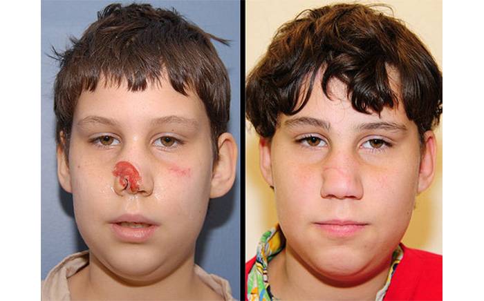 11 year old male who had lost part of his nose from an animal bite. The picture on the right shows his appearance 1 year after reconstruction. 
