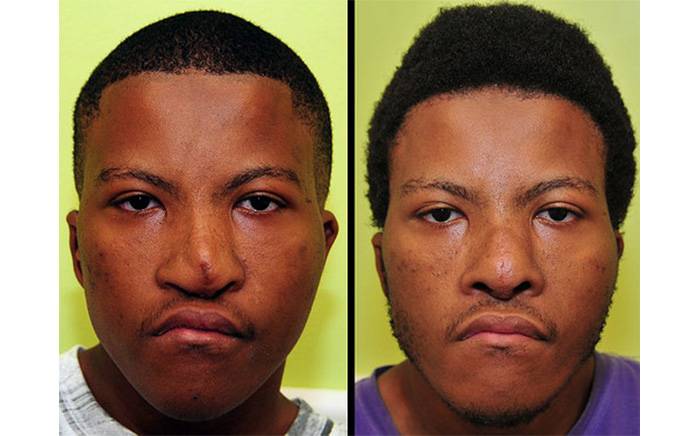 He had nasal reconstruction performed to improve his appearance and breathing.