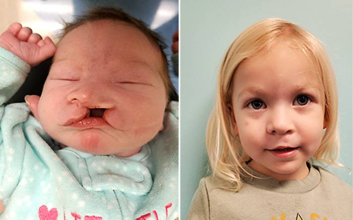 Cleft Lip and Nasal Reconstruction Pre Op and Post Op photos