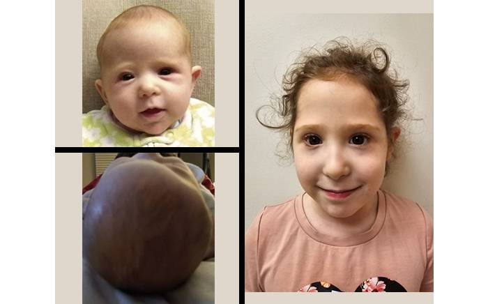 5-year-old after completion of helmet molding therapy and endoscopic-assisted treatment for right coronal synostosis.