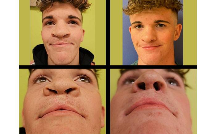 Before and after image of a cleft rhinoplasty surgery patient