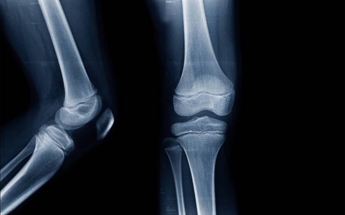 Growth Plate Injuries in Athletes: What Are They & When Should I Worry?
