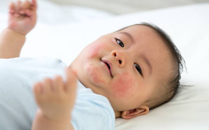 Let’s Talk About Hives in Children