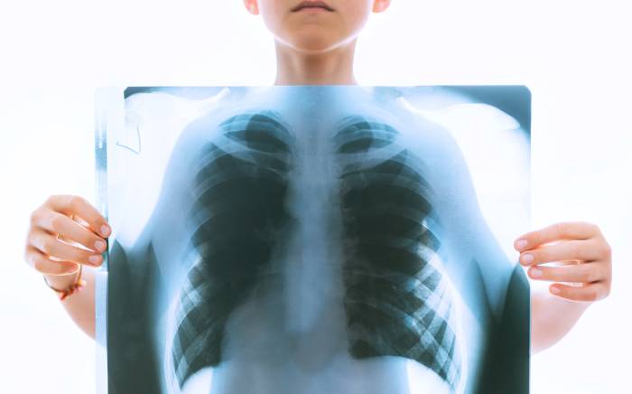 What Does the COVID-19 Infection Do to Your Lungs?