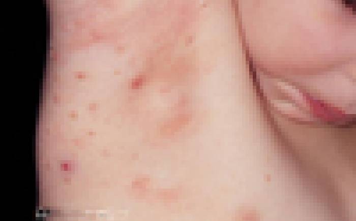Molluscum: What is this bumpy skin rash?