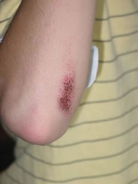 Abrasion on Elbow (3 Days Old)