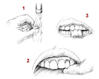 First Aid - Tooth - Knocked Out