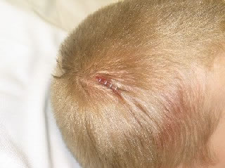 Laceration - Scalp (After Staples)